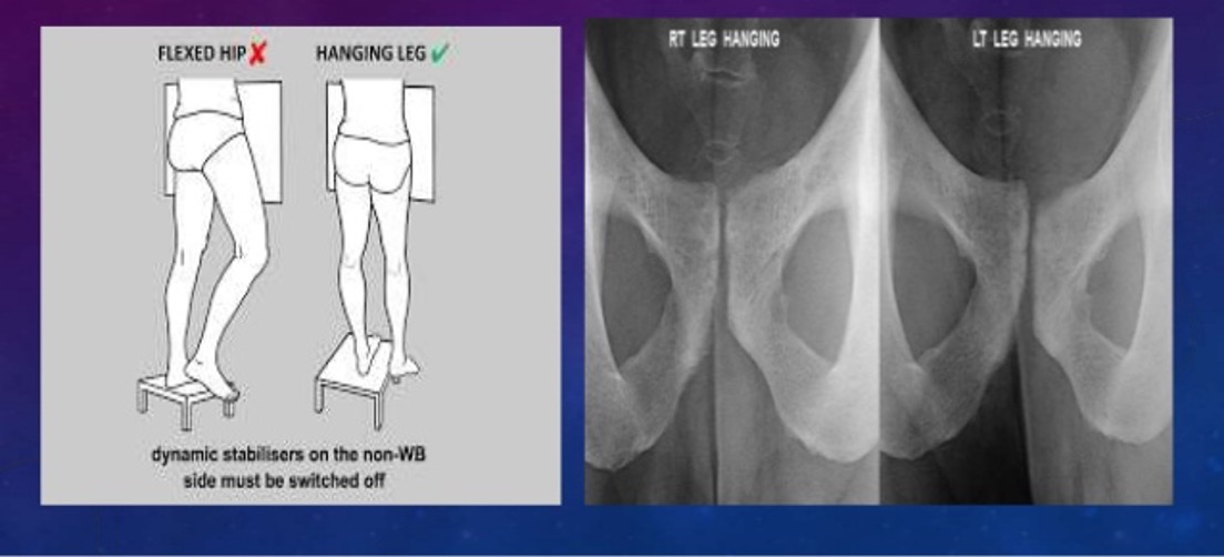 <p>specialized orthopedic serious consisting of 3 separate pelvis projections- neutral, left foot raised, right foot raised</p><p>looks for instability of pelvic ring</p>