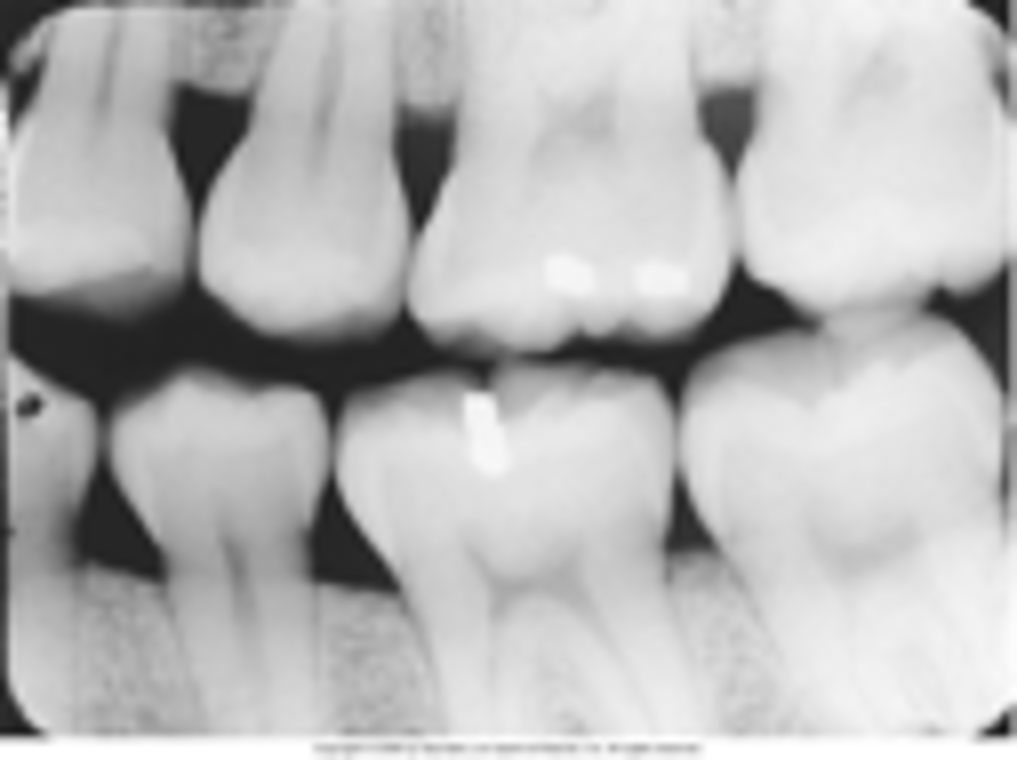 <p>dental X-ray film designed to show the crowns of the upper and lower teeth simultaneously. used to detect inter proximal decay</p>