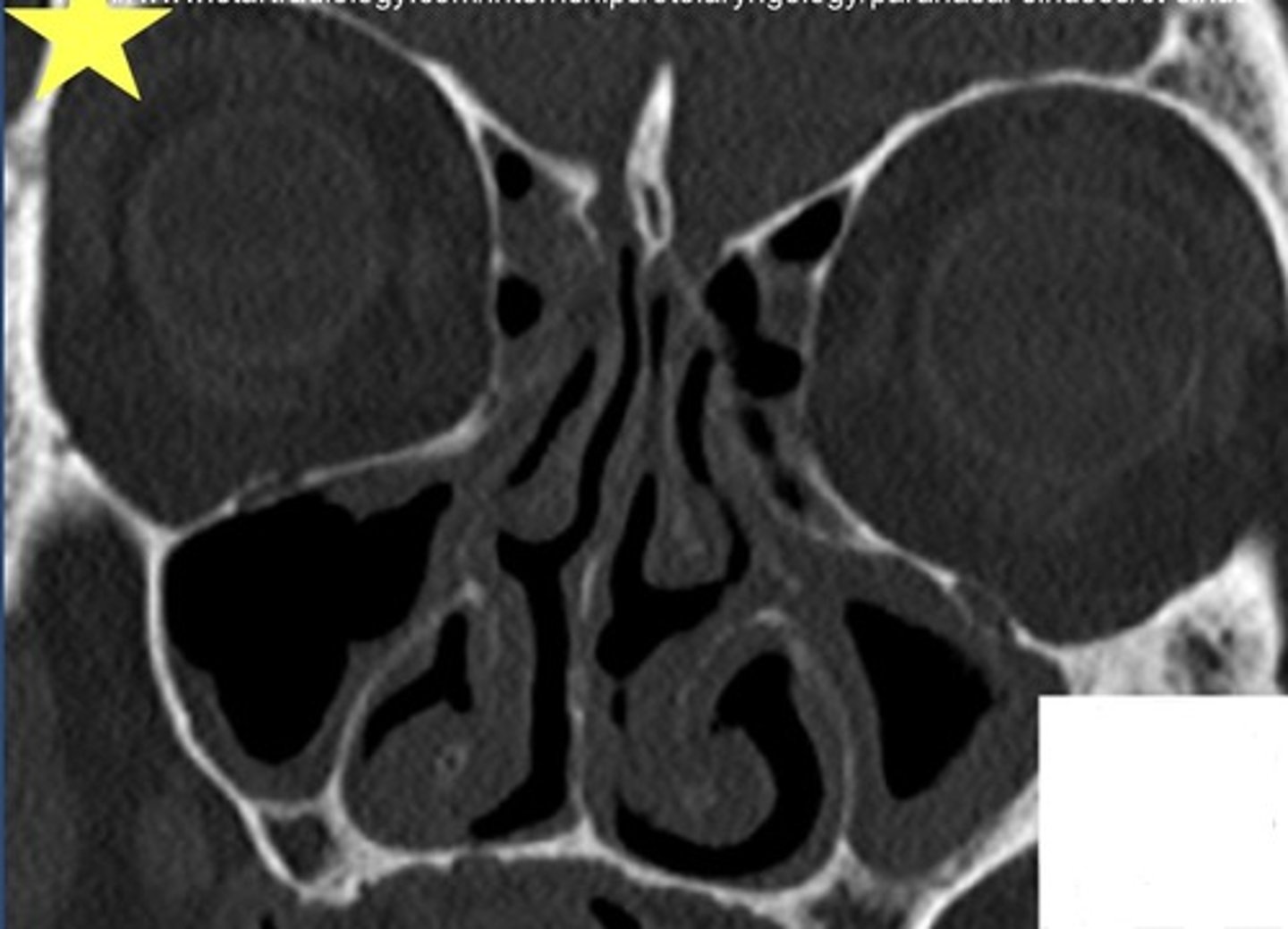 <p>Identify the radiographic abnormality. Also identify the imaging plane and modality used.</p>