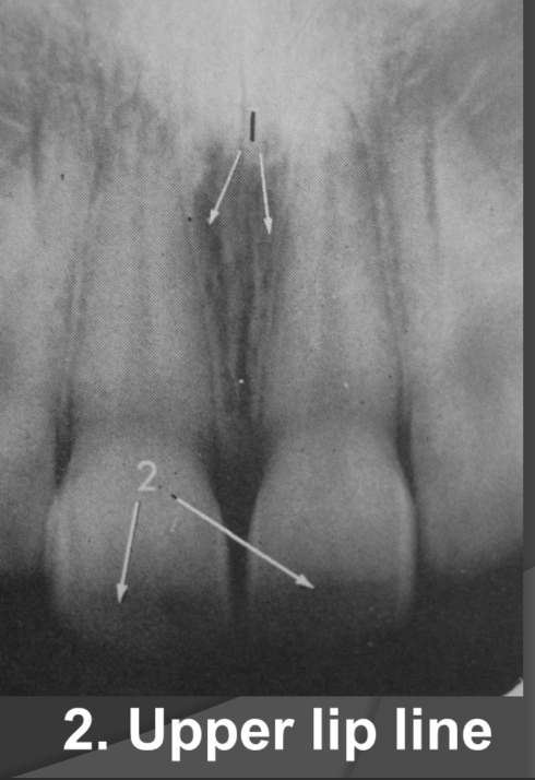<p>-Radiolucent</p><p>-Horizontal line that runs across the central incisors usually</p>