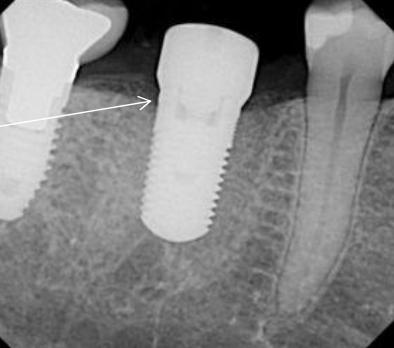 <ol><li><p>No implant mobility (No periodontal ligament)</p></li><li><p>No peri-implant radiolucency</p></li><li><p>Marginal bone loss not exceeding 0.2 mm after the first year</p></li><li><p>Absence of pain, infections, paresthesia or neuropathies</p></li></ol><p></p>