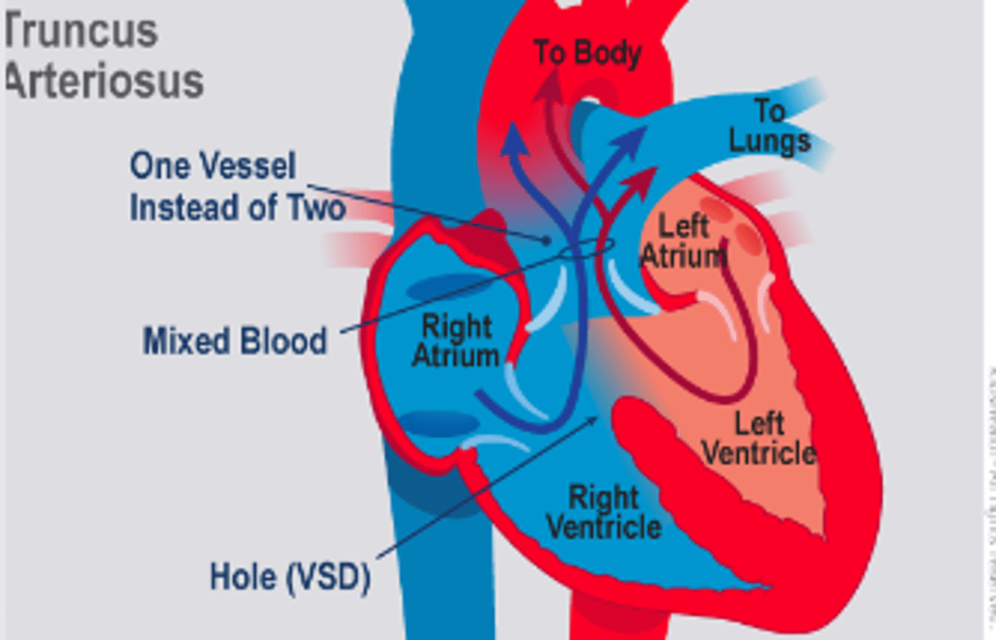 <p>A rare type of heart disease in which a single blood vessel (trunk) comes out of the right &amp; left ventricles, instead of the normal 2 vessels (pulmonary artery &amp; aorta).</p>