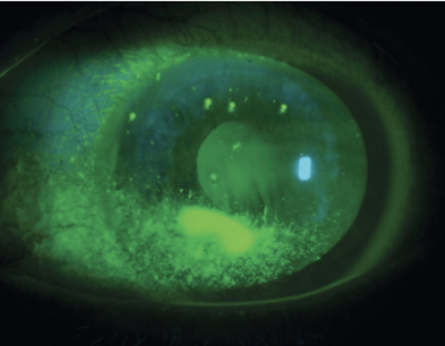 <p><u>Etio</u>: <strong>scratch</strong> of the surface of the cornea</p><p><u>Risk factors</u>: contacts, trauma, or FB</p><p><u>Complications</u>: Corneal ulcer</p><p><u>S&amp;S</u>: <strong>FB sensation, severe pain, photophobia</strong>, pt keeps eye closed</p><p><u>Testing</u>: fluorescein stain w/ positive uptake <strong>(linear)</strong></p><p><u>Tx</u>: <strong><u>FB or trauma:</u></strong> <strong>Erythromycin ophthalmic 0.5% ointment</strong>, avoid bright lights, wear sunglass, no contacts</p>