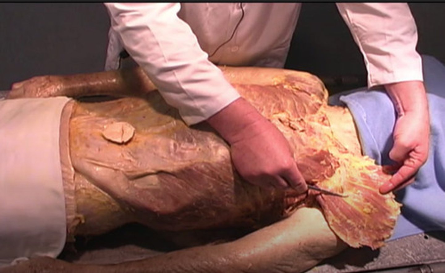 <p>Why do you not need to worry about destroying the nerves and arteries during this incision?</p><p>due to their location on the inferior spine</p><p>due to their location on the underside of the muscle</p><p>due to their location on the underside of the spine</p><p>due to the epidermis</p>