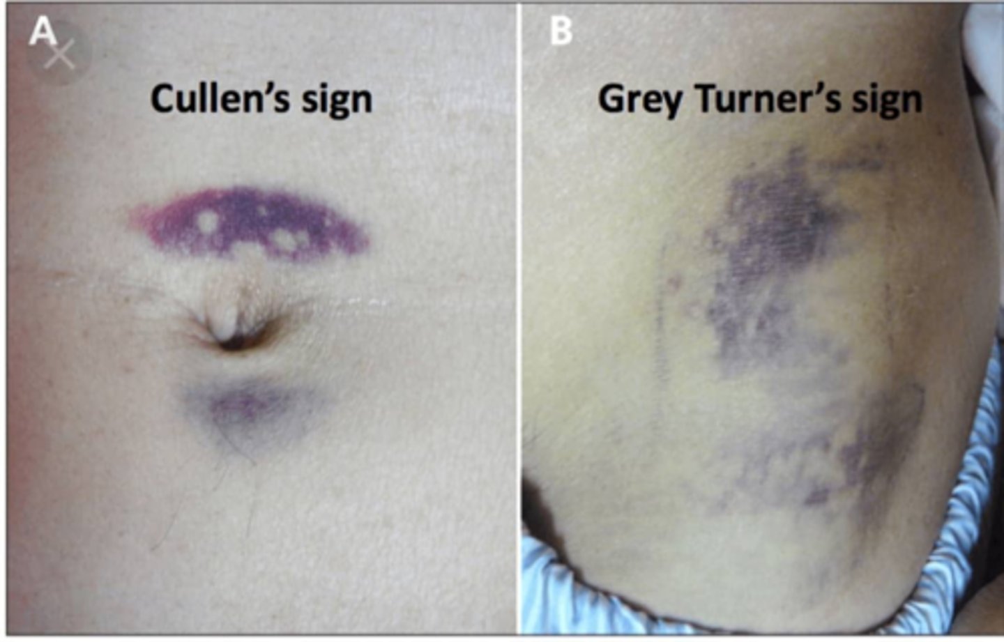 <p>- abdominal pain</p><p>- N/V</p><p>- fever</p><p>- jaundice</p><p>- weight loss</p><p>- skin bruising</p>