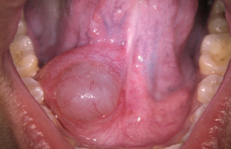 <p>If you have a mucocele on the floor of the mouth, what is it called?</p>