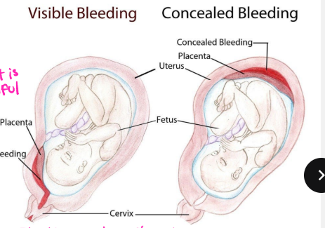 <p><strong>Placental Abruption: Background</strong></p><p>-Also known as abruptio placentae&nbsp;</p><p>-Premature ___________ of the placenta from the ________ at or after __ weeks gestation</p><ul><li><p>Decidua → specialized layer of endometrium that forms the base of the placental bed&nbsp;</p></li><li><p>Can be partial or complete&nbsp;</p></li></ul><p>-Pathophysiology → immediate cause is _______ of maternal ________ in the decidua basalis&nbsp;</p><ul><li><p>Can be acute or chronic&nbsp;</p></li></ul><p></p>