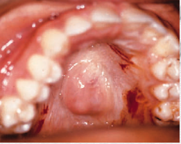 <p>referred as <span style="color: red;">benign mixed tumor</span></p><p>presents initially as a <span style="color: red;">dome shaped mass without </span><span style="color: red;">ulceration</span> or symptoms</p>