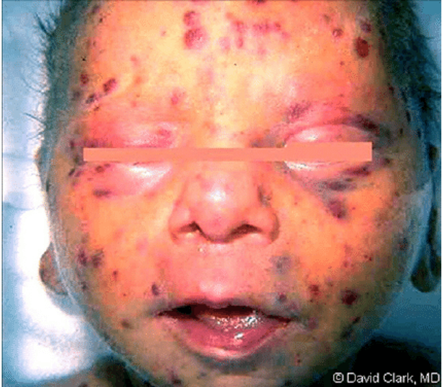 <p>What does this refer to</p><ul><li><p>Cervical lymphadenopathy</p></li><li><p>Petechial (“blueberry muffin”) rash</p></li></ul><p></p>
