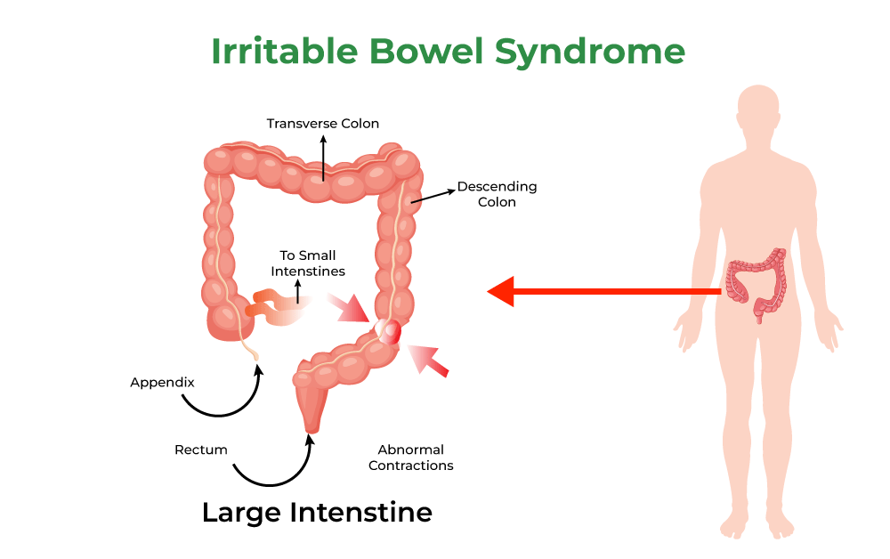 <p>An intestinal disorder causing pain in the belly, gas, diarrhea, and constipation. <span>Symptoms include abdominal pain, bloating, gas, change in bowel habits, abdominal swelling, diarrhea, and constipation.</span></p>