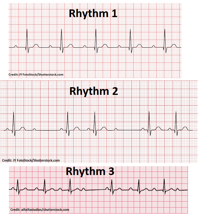 <p><span><strong>Which rhythm above is an ECG reading that represents a Second-Degree Type II Heart Block (Mobitz II)?</strong></span></p>
