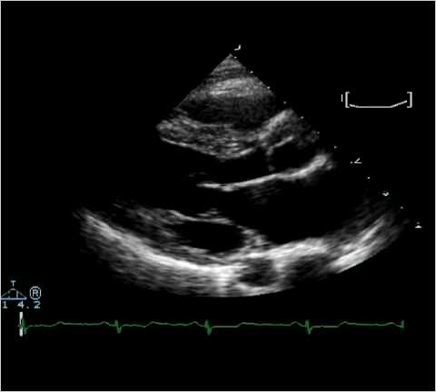 <p>What is 'Overall Gain' optimization in 2D echo?</p>