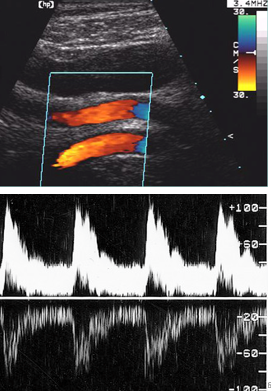 <ul><li><p>duplication of Doppler shifted echoes on the opposite side of a strong reflector or the baseline</p></li><li><p>causes: highly reflective surface, high Doppler gain, Doppler angles near 90 degrees</p></li></ul>