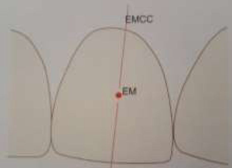 <p>Point in facial axis that separates the gingival half of the clinical crown from occlusal</p>