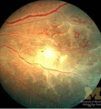 <p>ocular inflammation</p>