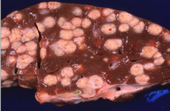 <p>Give a morphological diagnosis. What is the aetiology?</p>