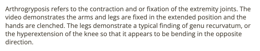 <p>a) arthrogryposis </p>