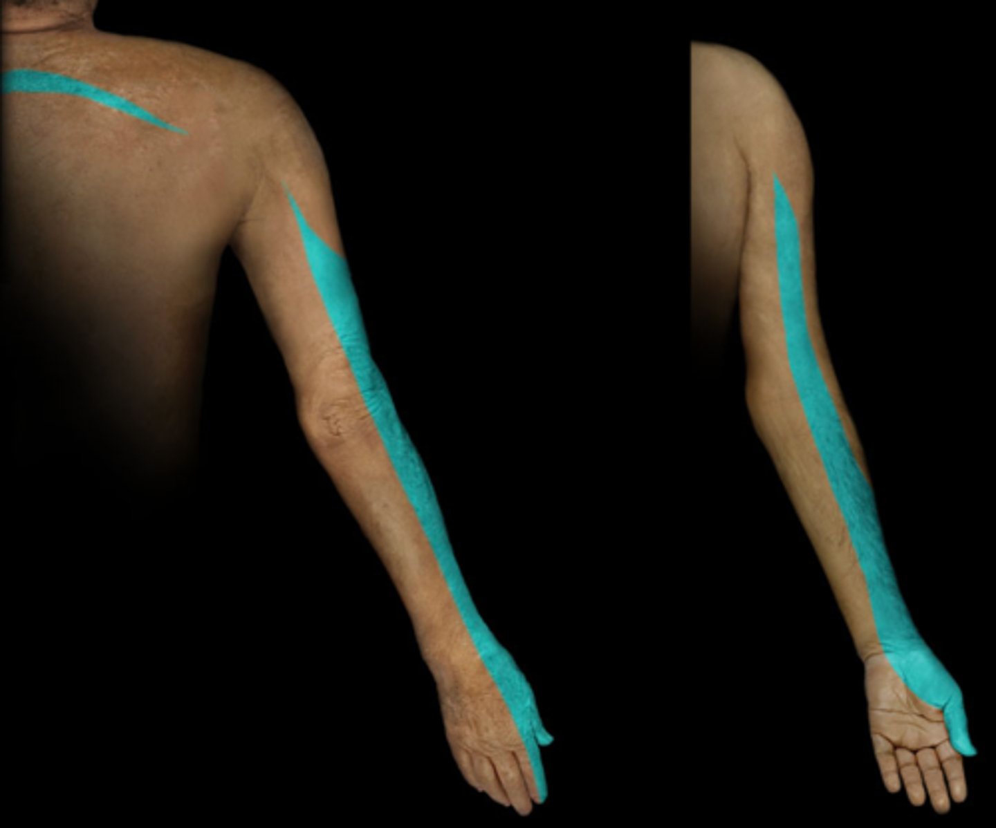 <p>Dermatome: Anterior arm, radial side of hand to thumb and index finger</p><p>Muscles innervated: Biceps, supinator, wrist extensors</p><p>Reflexes (if any): Biceps, brachioradialis</p><p>Paresthesias: Thumb and index finger</p>