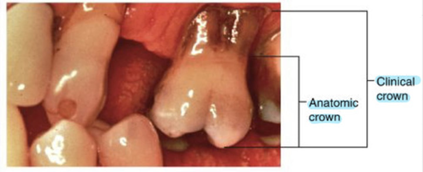 <p>the amount of tooth that is visible</p>