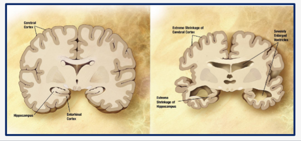 <p>Alzheimer’s Disease</p>
