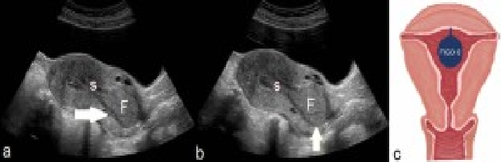 <p>what location is this fibroid in ?</p><p></p>