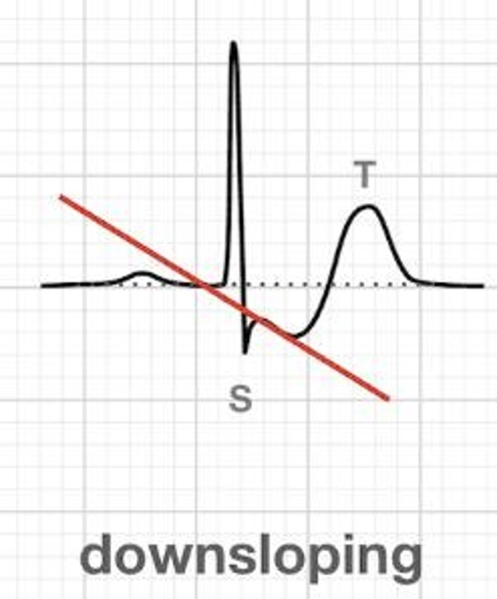 <p>It may suggest myocardial ischemia.</p>