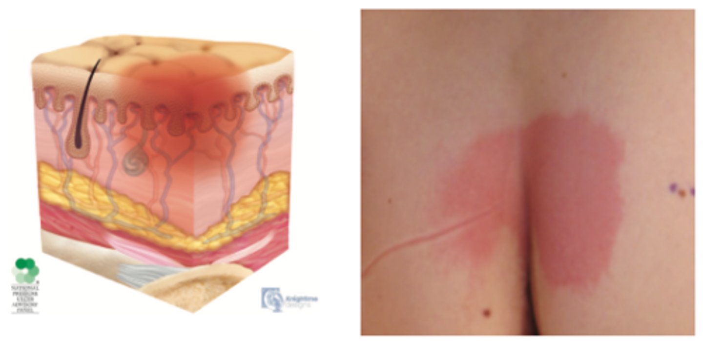 <p>intact skin with nonblanchable redness</p><p>usually over a bony prominence</p>