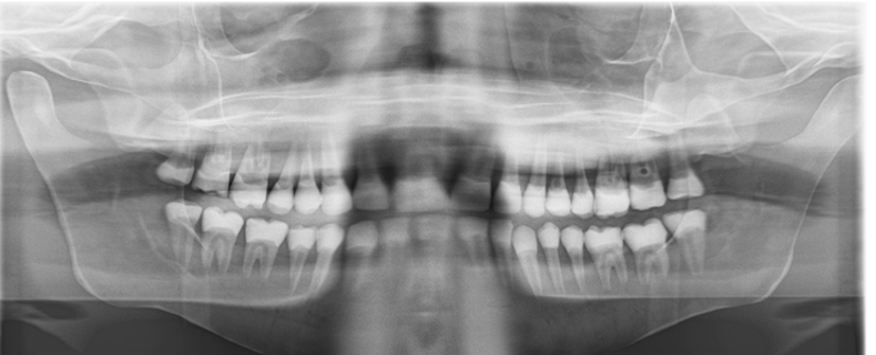 <p><span style="font-family: Aptos, sans-serif; line-height: 115%;"><span>Anterior teeth appear fat and out of focus</span></span></p><ul><li><p>big back</p></li></ul><p></p>
