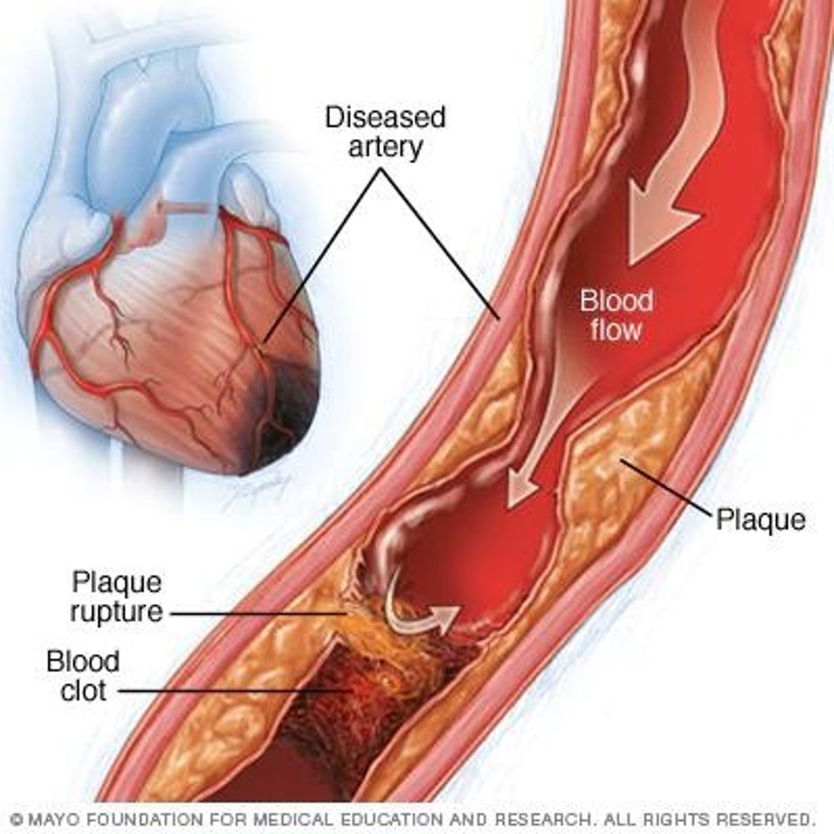 <p>Most common type of heart disease</p>