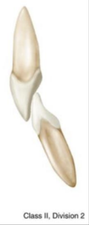 <p>retroclined max central incisors, more rare</p>