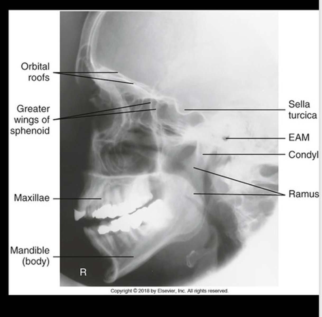 <p>All 4 sinuses</p><p>Superimposed facial bones</p>