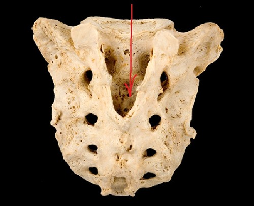 <p>Continuation of the vertebral canal that goes inside the sacrum and terminates near the coccyx via an enlarged opening called the sacral hiatus.</p>