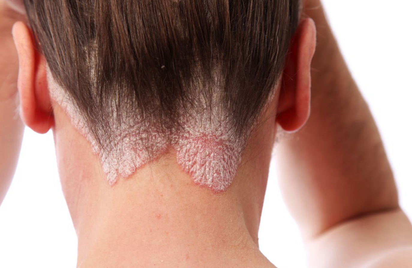 <p>what type of lesion and condition is depicted</p>