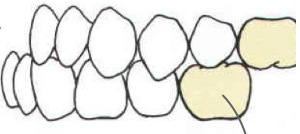 <p>type of occlusion</p>