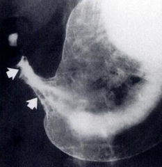 <p>What is wrong with this patient's stomach? This is an abnormal finding on a gastrogram<br />
Note: This image is human</p>