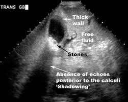 <p>Cholecystitis on US</p>