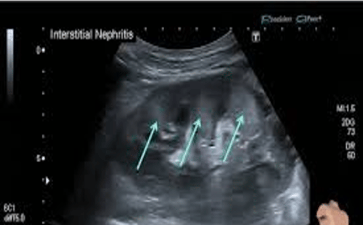 <p>Sonographically, acute interstitial nephritis appears with increased ___ ___ </p>