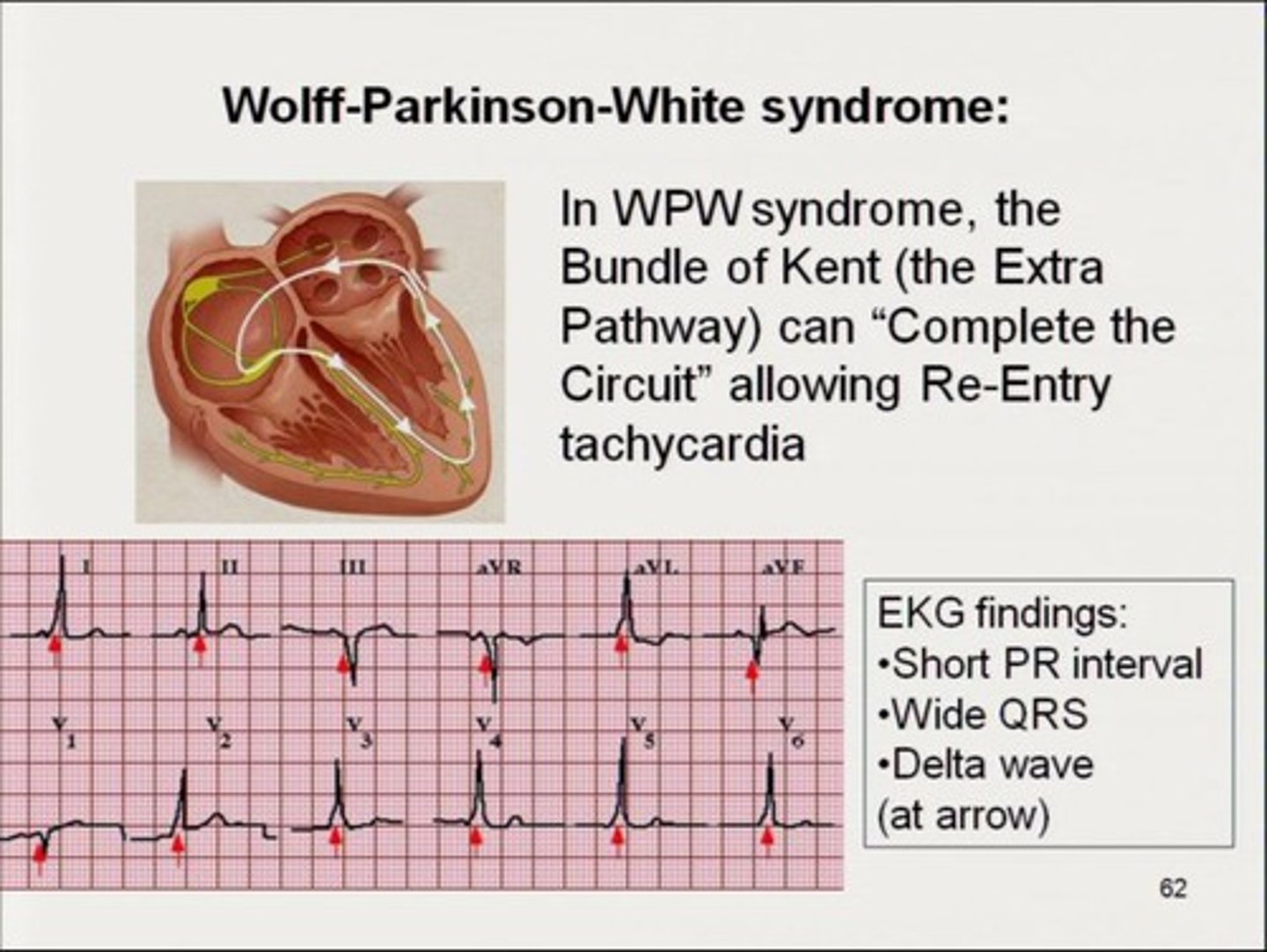 <p>Shortened PR interval, delta wave, widening QRS comlex</p><p>-> supraventricular tachy can result</p><p>-> accessory pathway between atria and ventricle resulting in pre excitation and INC risk tachyarrhythmias</p>