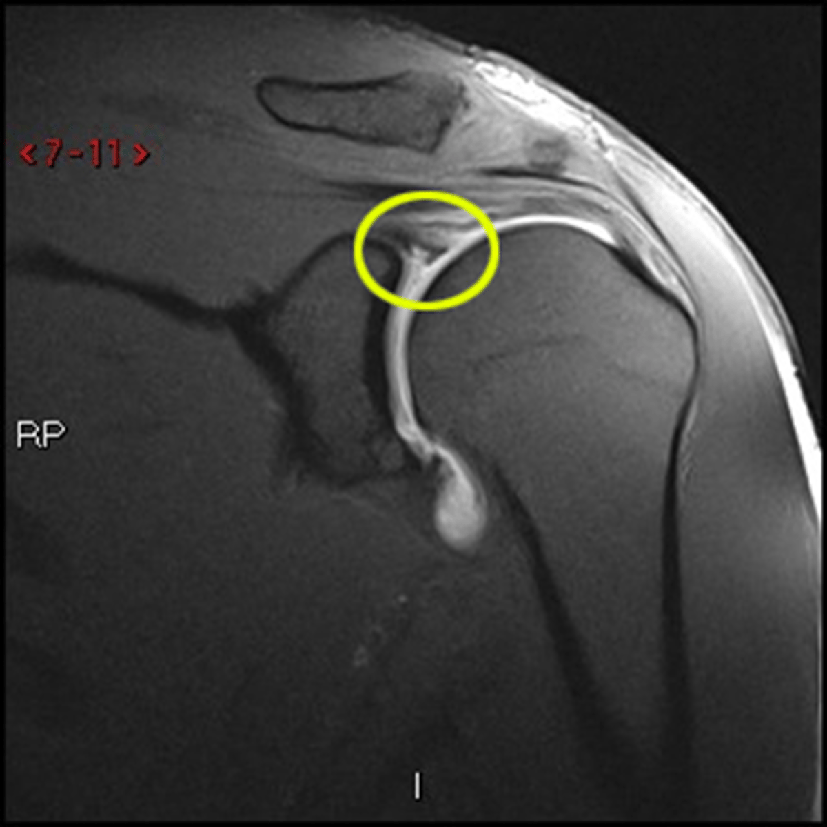 <p>Inject diluted gadolinium into a joint to distend the joint, and highlight tears of capsule</p>