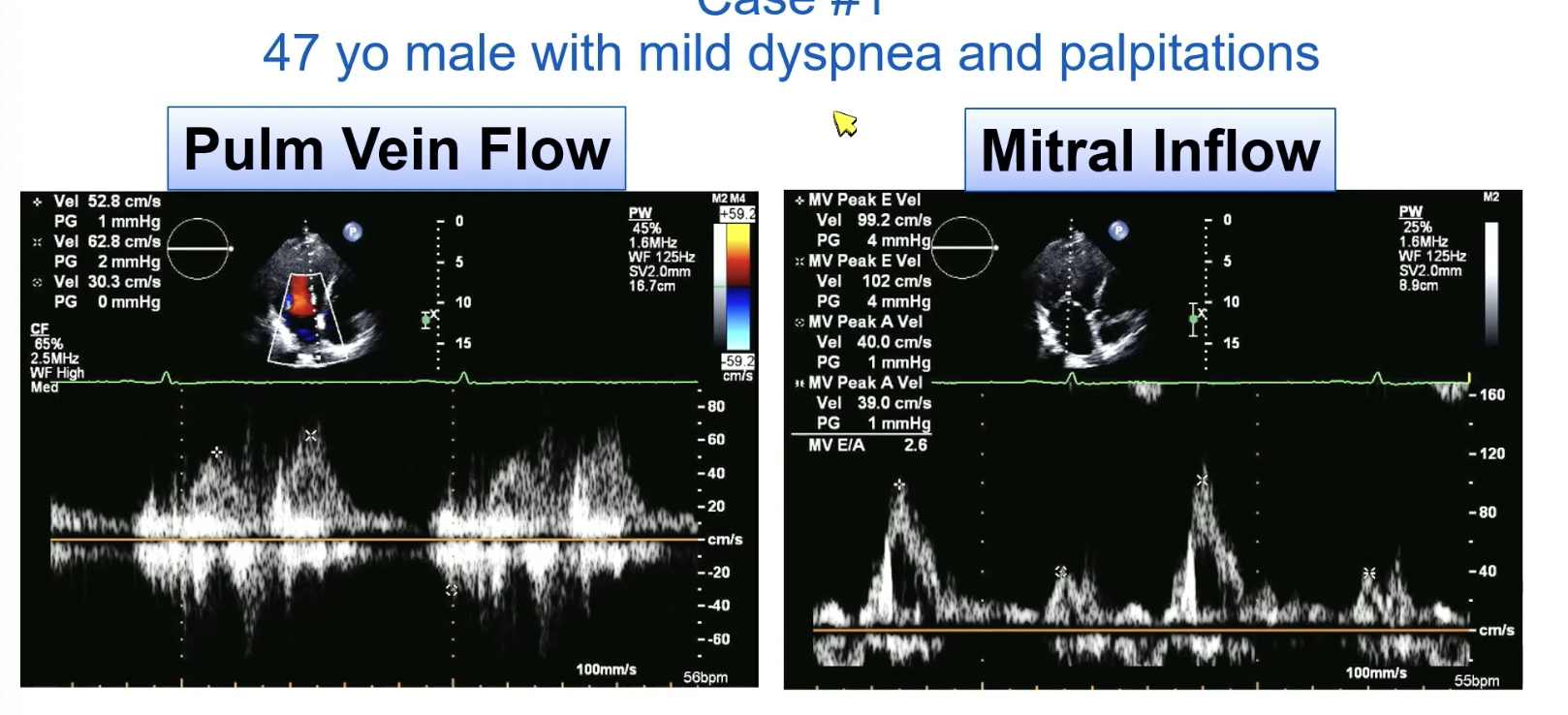 <p>FYI this is systolic blunting of the pulmonary veins </p>
