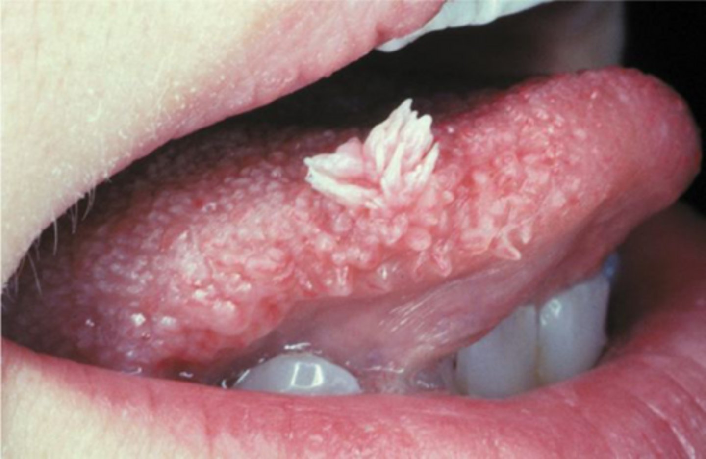 <p>papilloma</p>