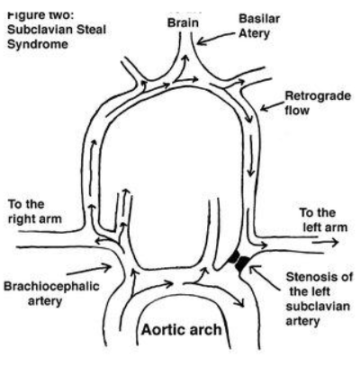 <p>retrograde vertebral flow </p><ul><li><p><strong>bi-directional </strong>or <strong>bunny sign </strong>if ‘pre’</p></li></ul><p>LT subclavian/innom occlusion that is proximal to vertebrals</p><p>brachial BP difference 15-20mmHg</p>