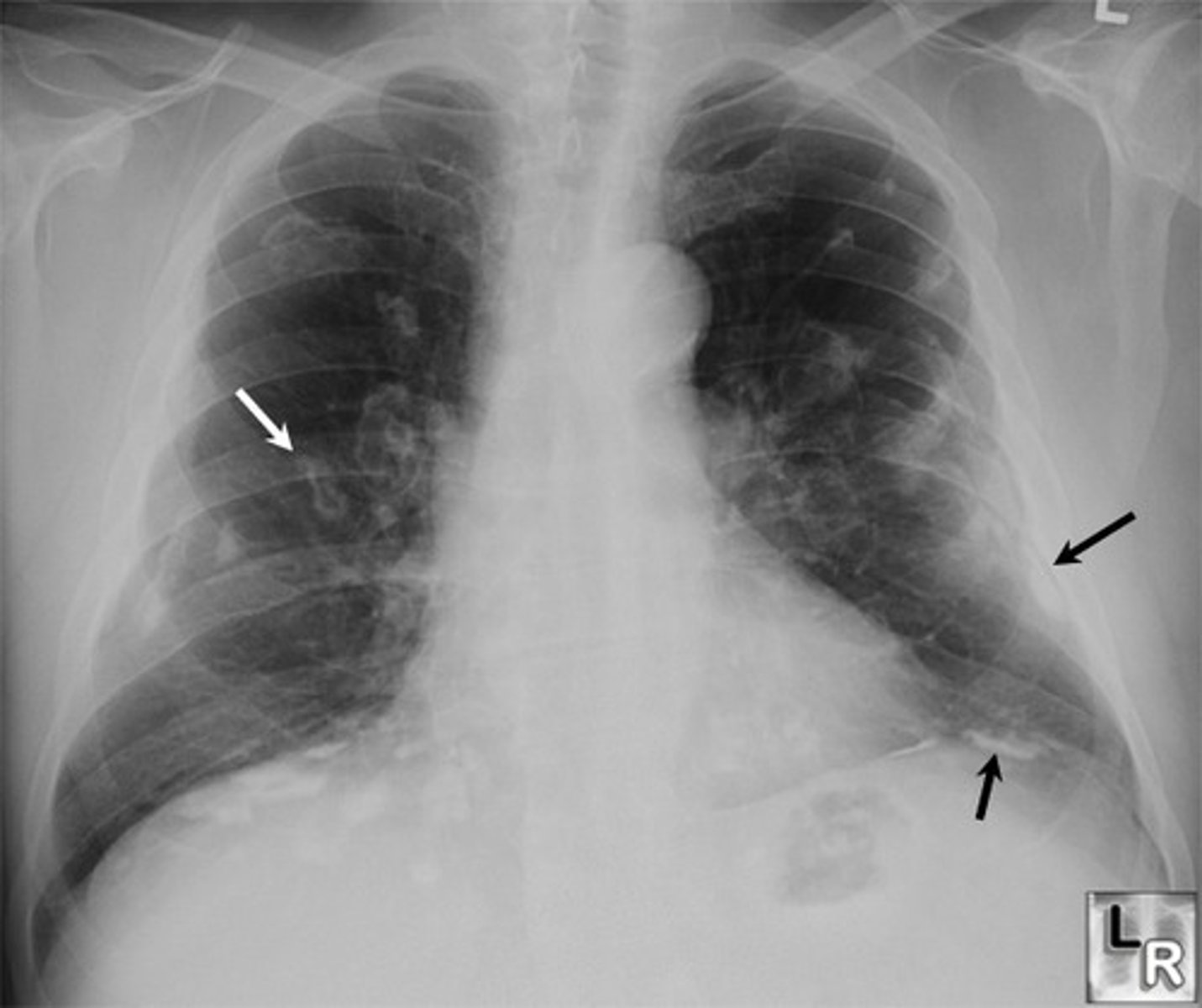 <p>Scar tissue is produced in the lungs, and it thickens the alveoli, so gaseous exchange is slowed and breathing becomes more difficult</p>