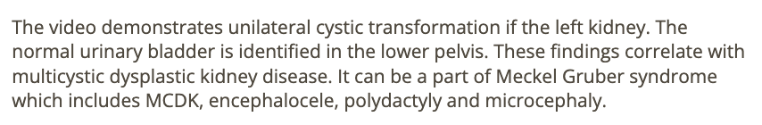 <p>c) unilateral multicystic dysplastic kidney</p>