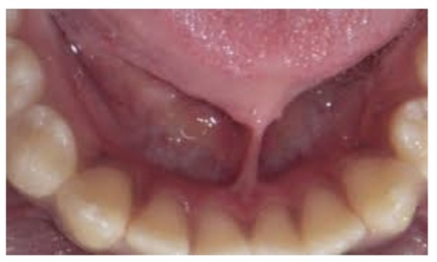 <p>An extensive adhesion of the tongue to the FOM. Can effect feeding and speech. Treatment: frenectomy</p>