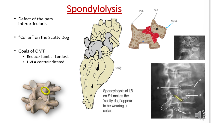 <p><span>•Defect of the pars interarticularis without anterior displacement of vertebral body.</span></p><p><span>•“Collar” on the Scotty Dog</span></p><p><span>•Goals of OMT: Reduce Lumbar Lordosis; HVLA contraindicated</span></p><p></p>