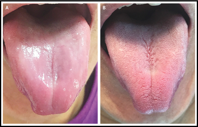 <p>outline atrophic glossitis </p>