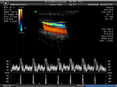 <p>Which of the following is present in this Doppler wave form?</p>
