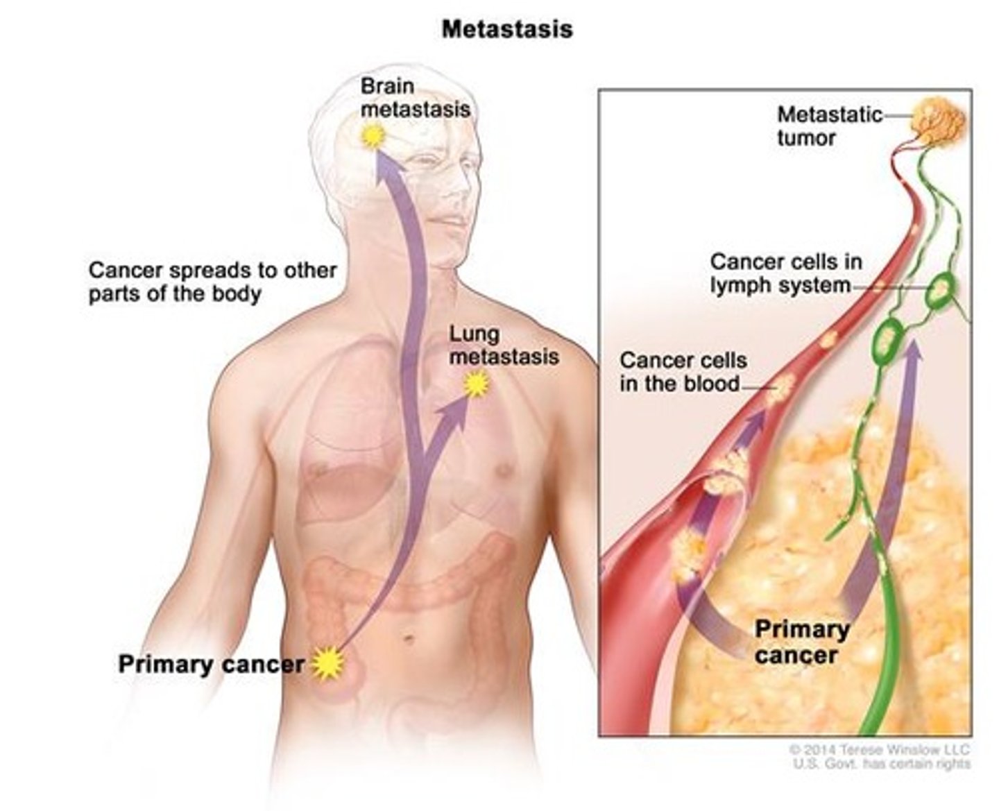 <p>the spreading of cancer (through the blood). Tumor are set up in other parts of the body</p>
