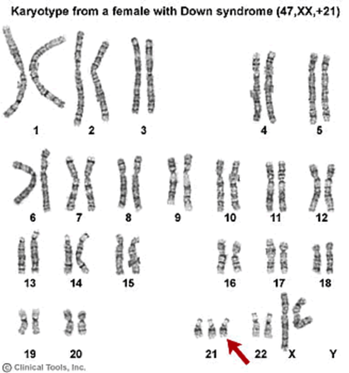 <p>A genetic disorder caused by an extra copy (complete or partial) of chromosome 21; causes developmental delays and physical disabilities</p>